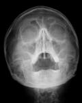 Расшифровка рентген-снимка пазух носа фото 1