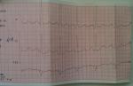 Прошу посмотреть кардиограмму, плохое самочувствие фото 1