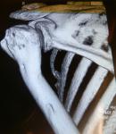 Деформация плечевой кости фото 2