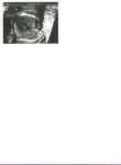 Гиперэхогенный фокус в полости левого желудочка плода фото 1