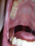 Воспаление в полости рта, после увулита фото 1