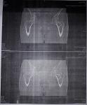 Энхондрома шейки левой бедренной кости фото 3