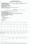 Экстрасистолы и выпадения комплексов QRST фото 1