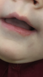 Покраснение на нижней губе фото 1