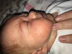 Аллергия и акне у месячного ребёнка фото 1