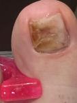 Пятнышки на ногтях: травматический онихозилис фото 2