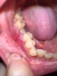 Удаление зуба с периодонтитом фото 1