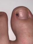 Меланома под ногтевой пластиной фото 1