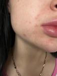 Сыпь вокруг рта, аллергия или нет? фото 1