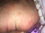 Акне новорожденных или аллергия? фото 2