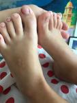 Шишка на большом пальце ноги ребенка фото 1