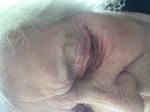 Зуд и покраснения кожи вокруг глаз женщина 78 лет фото 1