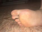Травма большого пальца на правой ноге фото 3