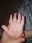 Красные пятна на ладошках у ребёнка 2 года фото 2