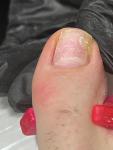 Пятнышки на ногтях: травматический онихозилис фото 3