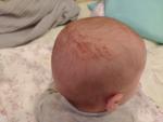 Мокнущая рана под желтыми корочками на голове младенца фото 1