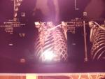 Застарелый перелом грудины с признаками неоартроза фото 1