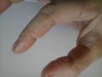 Шершавая коже на пальце, черные трещины фото 2