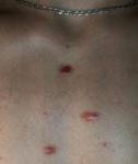Красные пятна на груди, инфекционные гранулемы фото 2