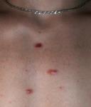 Красные пятна на груди, инфекционные гранулемы фото 1
