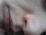 Болячка на носу фото 1