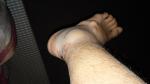 Травма голеностопа реабилитация фото 3