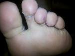 Болезненные ранки между пальцев ног фото 1