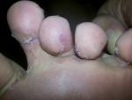 Болезненные ранки между пальцев ног фото 3