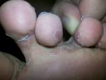Болезненные ранки между пальцев ног фото 2