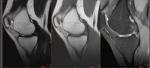 Расшифровка МРТ колена фото 5