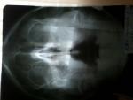 Гайморит на рентген снимке фото 1