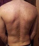Непонятные пятна на спине и груди на протяжении более 5 лет фото 1