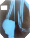 Перелом левой плечевой кости в н/3 со смещением фото 1