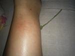 Прыщи и шелушение на коже ног фото 1