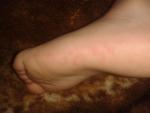 Подкожные красные пятна на ступнях и ладонях фото 3