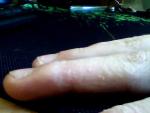 Пузырьки на коже пальцев фото 2