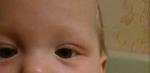 Покраснение кожи у ребенка вокруг глаз фото 2