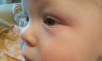 Покраснение кожи у ребенка вокруг глаз фото 1