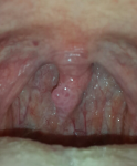 Опух язычок в горле фото 1