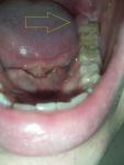 Вздутие десны со стороны языка последнего зуба фото 2