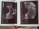 Миома или беременность фото 1