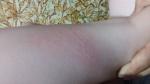 Аллергия в виде высыпаний на коже у ребенка фото 2