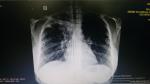 Инфильтративный туберкулез фото 2