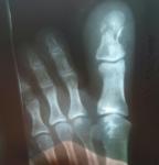 Перелом большого пальца ноги со смещением фото 2