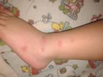Красные маленькие волдыри похожие на укусы комаров фото 1