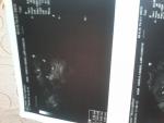 Подозрение на замершую беременность, анализ на ИППП фото 4