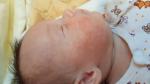 Аллергия или акне новорожденного фото 3