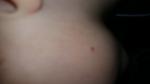 Сыпь на теле ребенка кровянистые пузырики фото 1