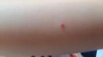 Красное пятнышко с кровью внутри у ребёнка фото 1