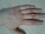 Проблема с кожным покровом кистей рук фото 1
